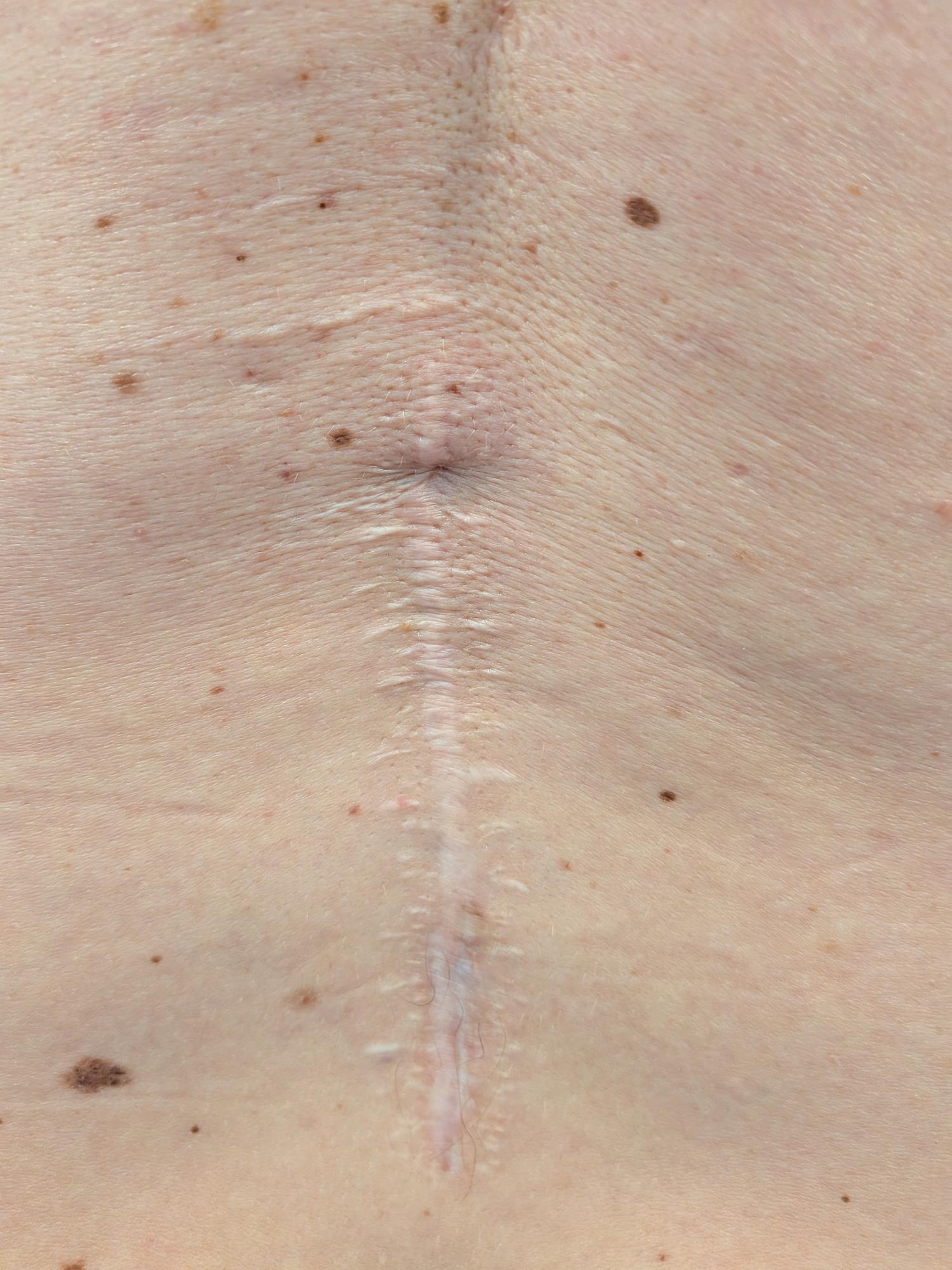 Scar work in progress on the back