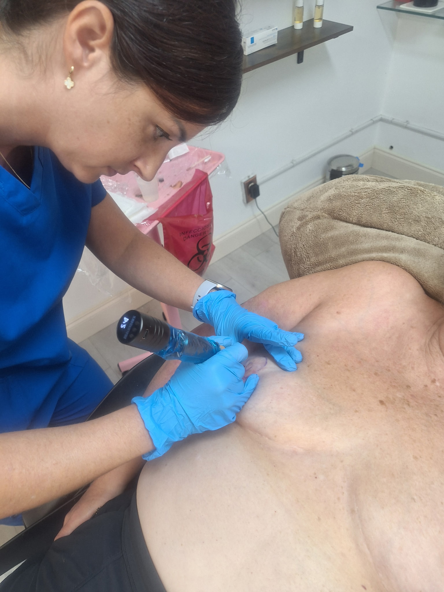 Areola restoration in progress
